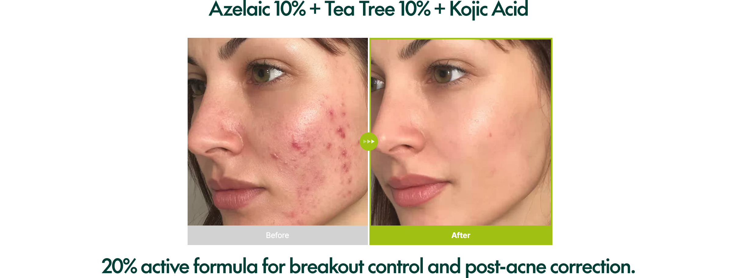 Azelaic Acid 10 Kojic Tea Tree Serum