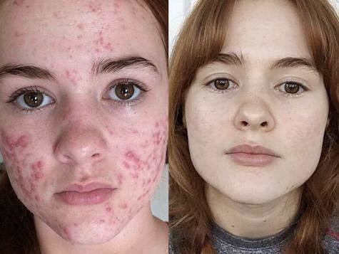 Adapalen gel ( Differin) 0.1 %